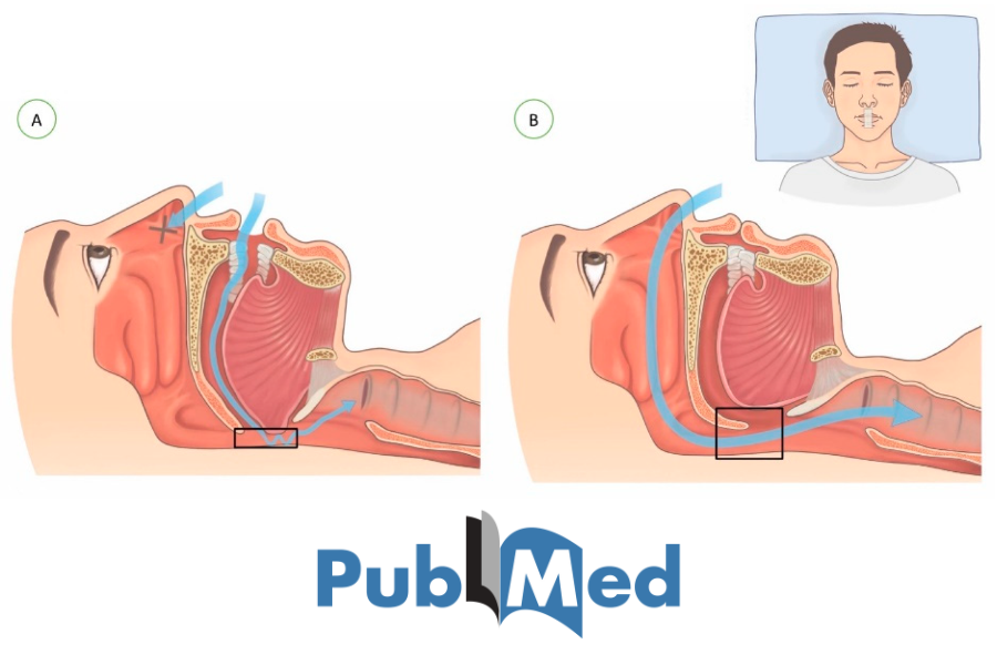 Tackling Mild Obstructive Sleep Apnea with Mouth Taping: Insights from a Clinical Study